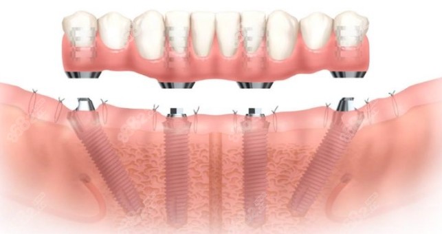 all-on-4全口种植牙
