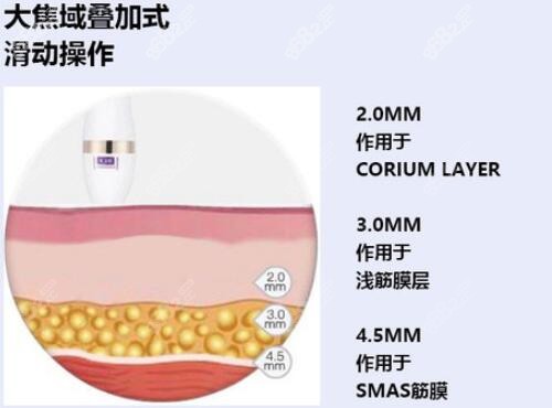 超声炮作用的皮肤层次