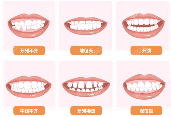 正雅经典牙套矫正牙齿问题