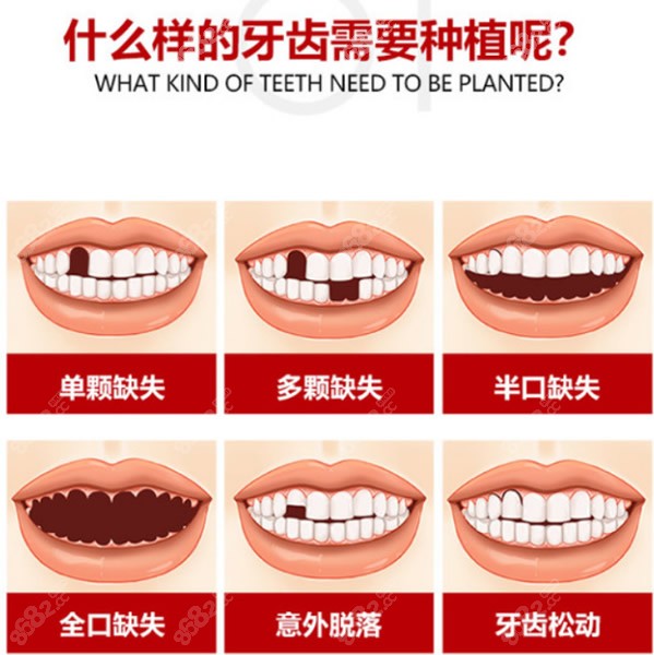 种植牙适合哪些牙齿情况