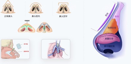 八大处鼻综合手术过程