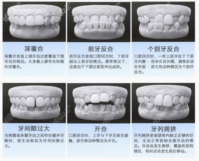 以下牙齿情况都可以通过矫正进行改善