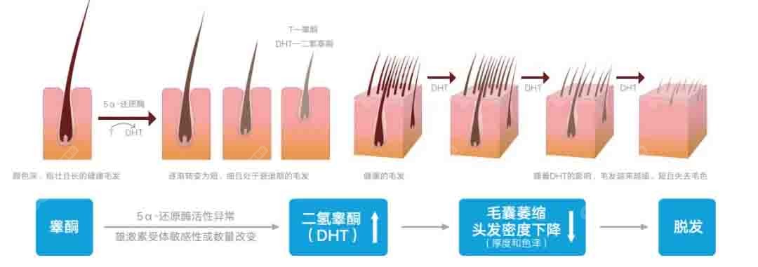 雄激素脱发过程