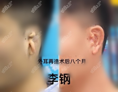 郑州大学第2附属医院李钢耳再造术前术后对比