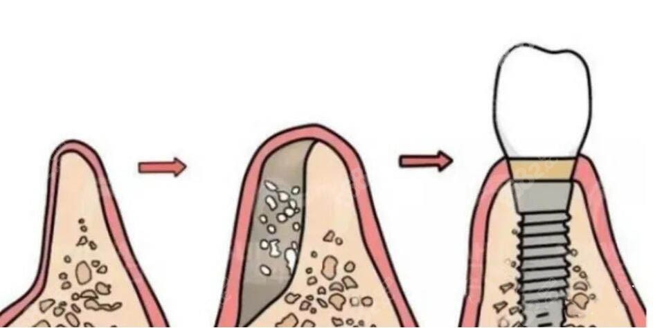 牙槽骨缺失种植牙流程