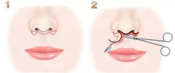 鼻基底下缩短法手术方法