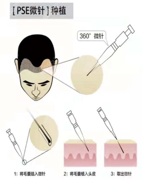 天津大麦微针植发技术
