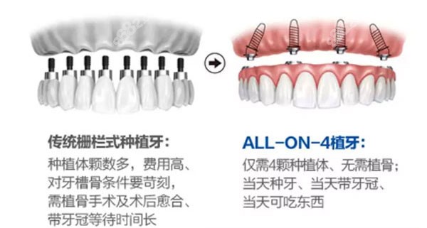 ALL-ON-4（6）种植牙