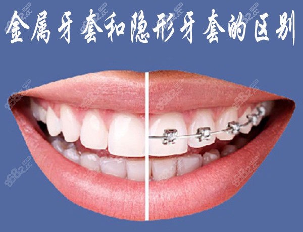 金属牙套和隐形牙套的区别