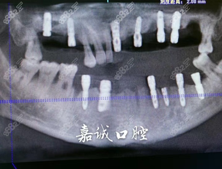 <!--<i data=20240705-sp></i>-->口腔医院种植牙