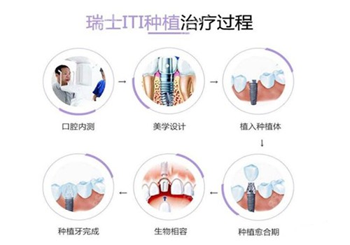 瑞士ITI种植牙过程