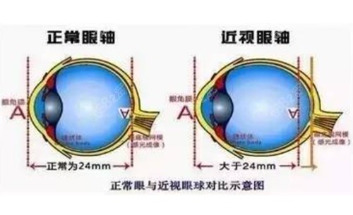 近视引起的突眼