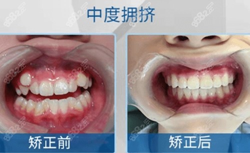 口腔矫正牙齿怎么样？