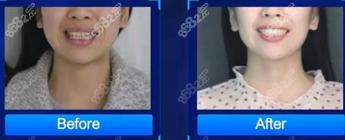 成都新桥牙齿矫正前后对比照