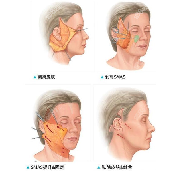 拉皮手术过程展示图