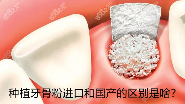 国产种植牙骨粉和进口的有啥区别