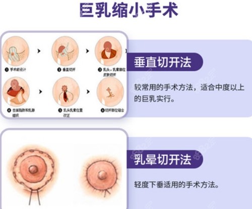 上海市东方医院巨乳缩小手术方式