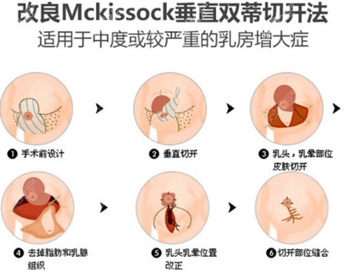 上海时光整形外科巨乳缩小优势介绍