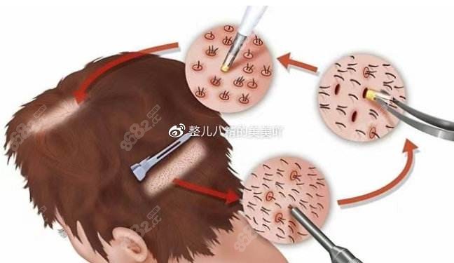 毛发移植价格如何计算