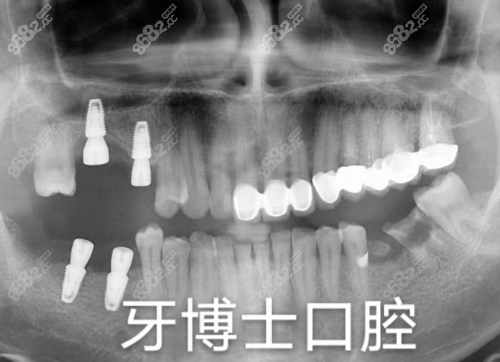 赣州牙博士黄燕院长做种植牙术后