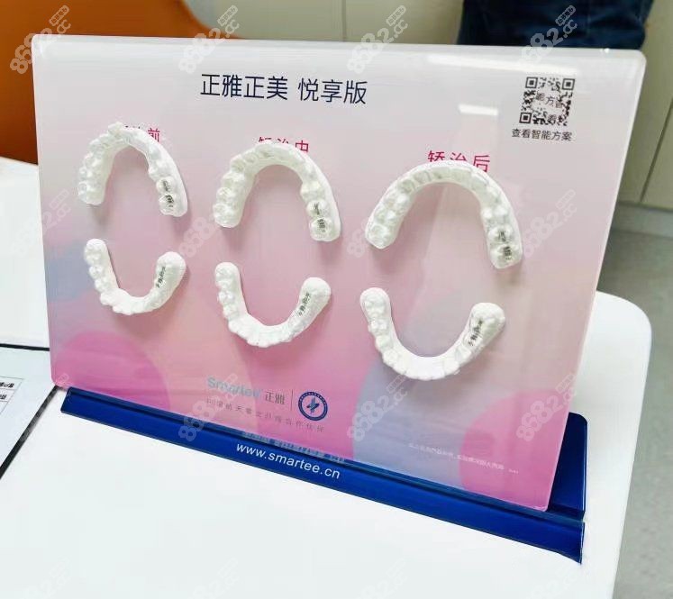 正雅隐形牙套前后对比图
