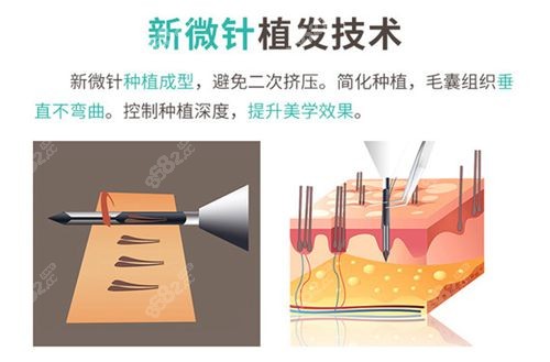 重庆<!--<i data=20240705-sp></i>-->植发微针技术