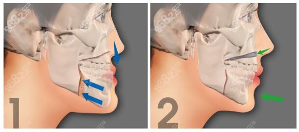 地包天做单颌手术和双颌的区别