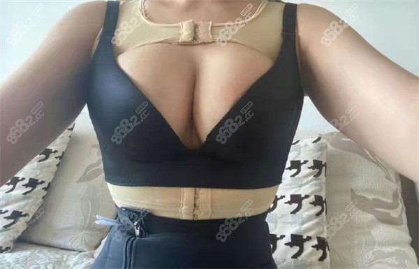 脂肪填充实例1