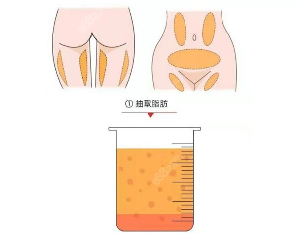 吸脂手术