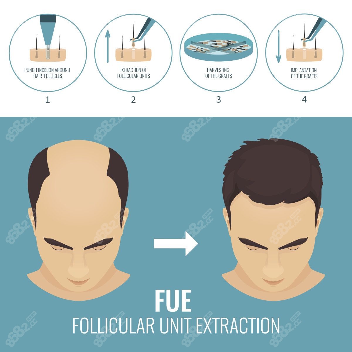 fue植发技术过程