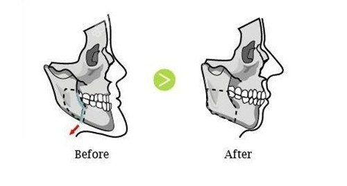 地包天双颌手术前后对比