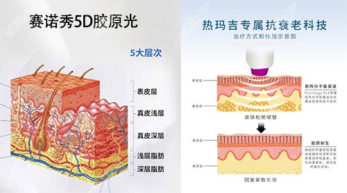 赛诺秀5D胶原光和热玛吉哪个好技术原理对比