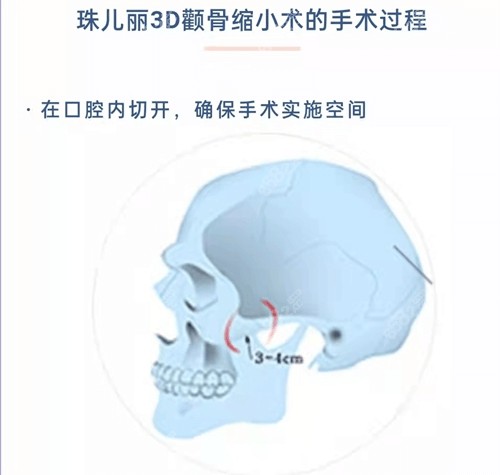 韩国珠儿丽医院颧骨整形好吗