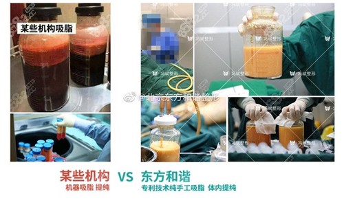 <!--<i data=20240705-sp></i>-->和谐的冯斌医生吸脂特色