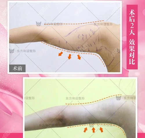 <!--<i data=20240705-sp></i>-->和谐的冯斌医生手臂吸脂对比