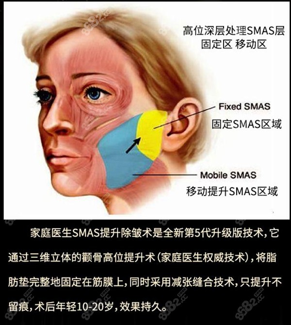 广州中家医家庭医生筋膜除皱术