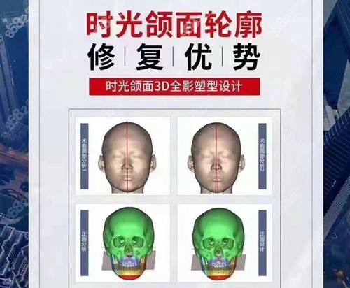 上海时光整形医院做磨骨手术的3d数字化技术