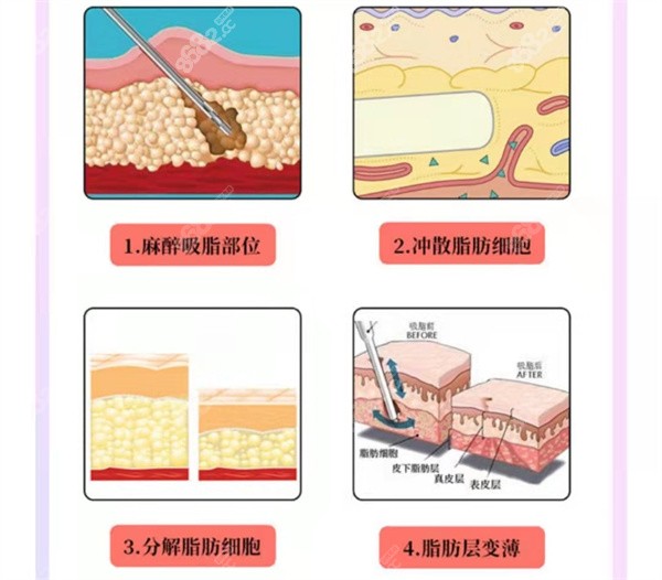 吸脂