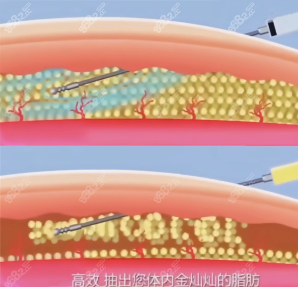 微震环吸手术的抽脂原理