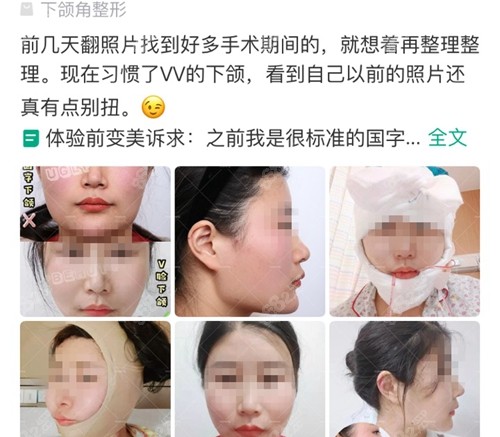 网友在上海时光整形医院找何晋龙医生下颌角磨骨手术评价口碑