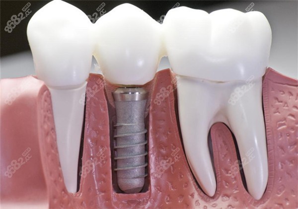 种植体在牙槽骨内的表现