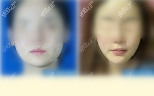 杜本军磨骨前后对比照