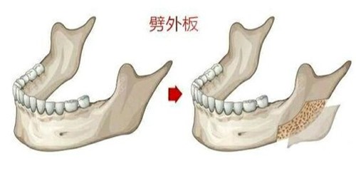 劈外板