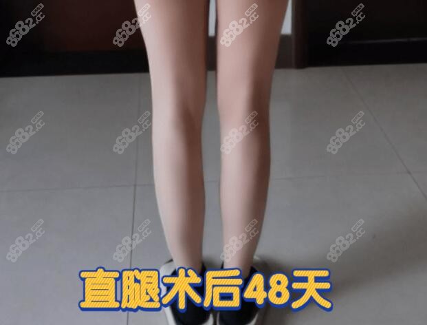 李奇军医生直腿术后48天