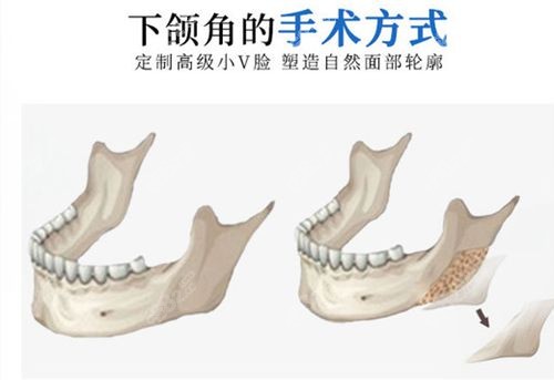 河南<!--<i data=20240705-sp></i>--><!--<i data=20240705-sp></i>--><!--<i data=20240705-sp></i>-->医院下颌角手术