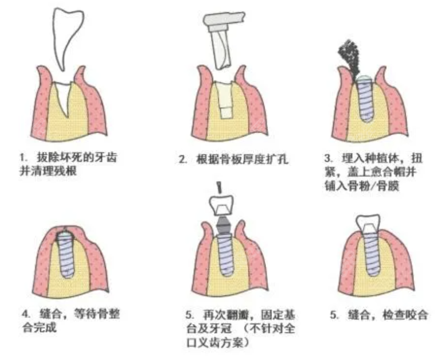 两段式种植体的操作流程