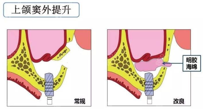 长春雅贝嘉齿科上颌窦外提升