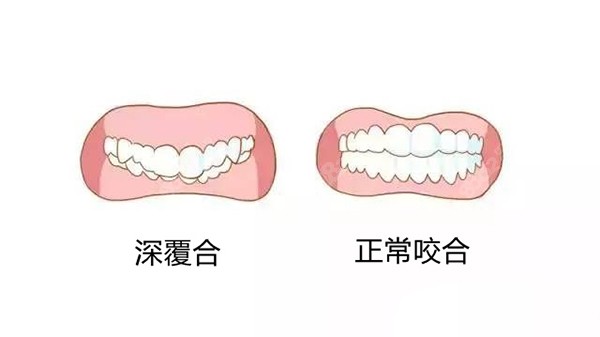 牙齿矫正平导改善深覆合