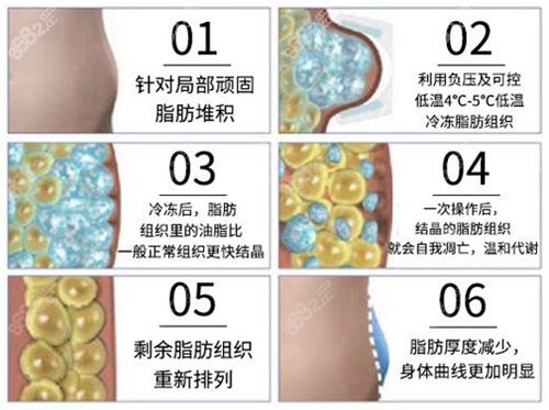 深圳非凡塑冷冻溶脂