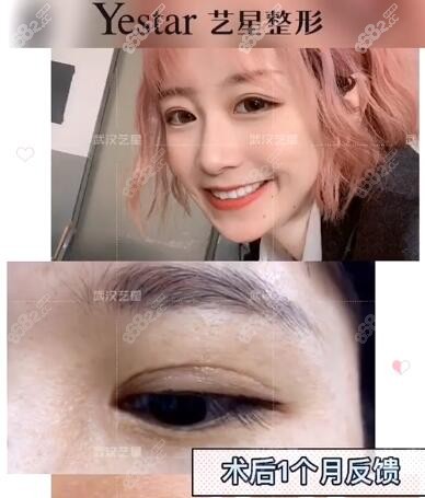 姜涛医生双眼皮术后一个月反馈